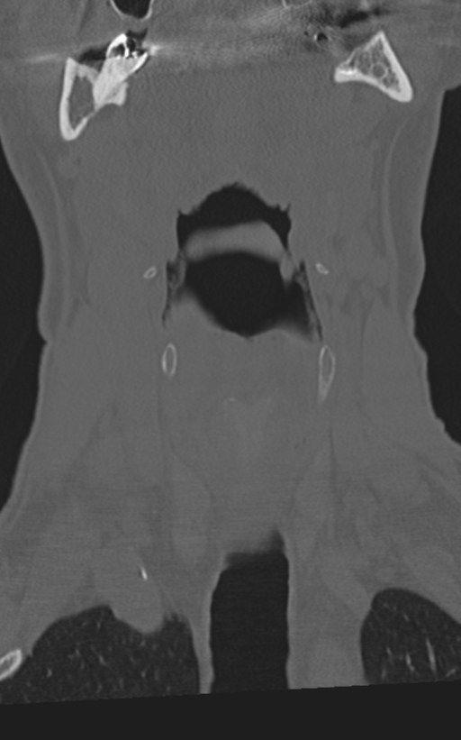 Cervical spine fractures with vertebral artery dissection (Radiopaedia 53296-59268 Coronal bone window 12).png