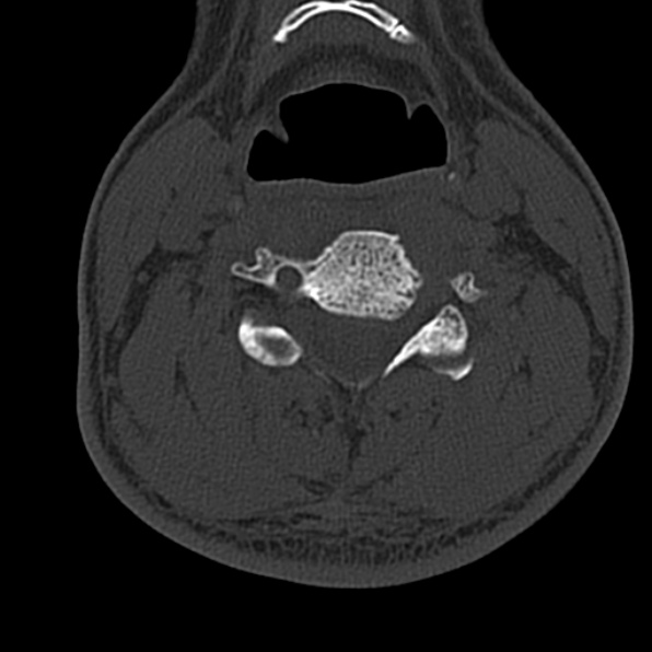 Cervical spondylodiscitis (Radiopaedia 28057-29489 Axial bone window 42).jpg