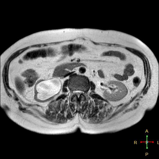 File:Cervical stump squamous cell carcinoma (Radiopaedia 48049-52858 I 2).jpg