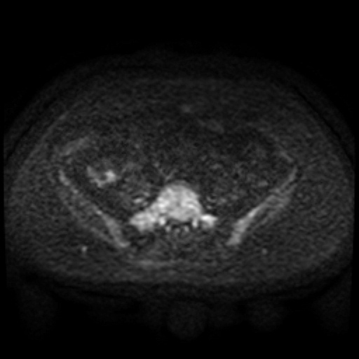 File:Cesarian section scar endometriosis (Radiopaedia 66520-75799 Axial DWI 76).jpg