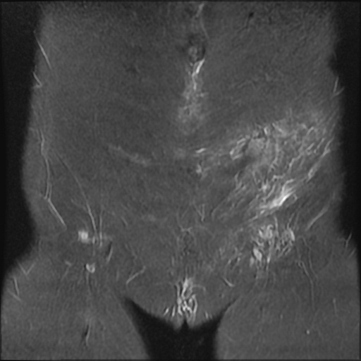 File:Cesarian section scar endometriosis (Radiopaedia 66520-75799 Coronal STIR 3).jpg