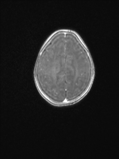 Chiari III malformation with occipital encephalocele (Radiopaedia 79446-92559 Axial T1 C+ mpr 67).jpg
