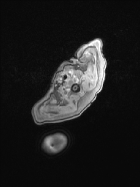 Chiari III malformation with occipital encephalocele (Radiopaedia 79446-92559 Axial T1 C+ mpr 9).jpg