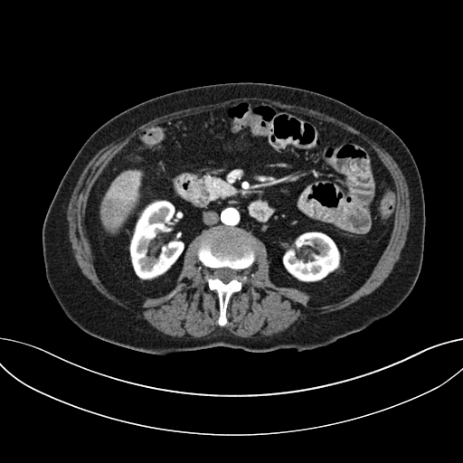 Cholecystoduodenal fistula due to calculous cholecystitis with gallstone migration (Radiopaedia 86875-103077 A 33).jpg