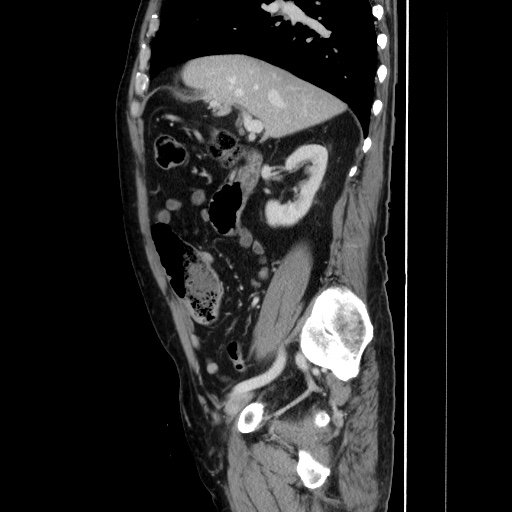 Choledocholiathiasis with normal caliber common bile duct (Radiopaedia 75368-86632 D 62).jpg