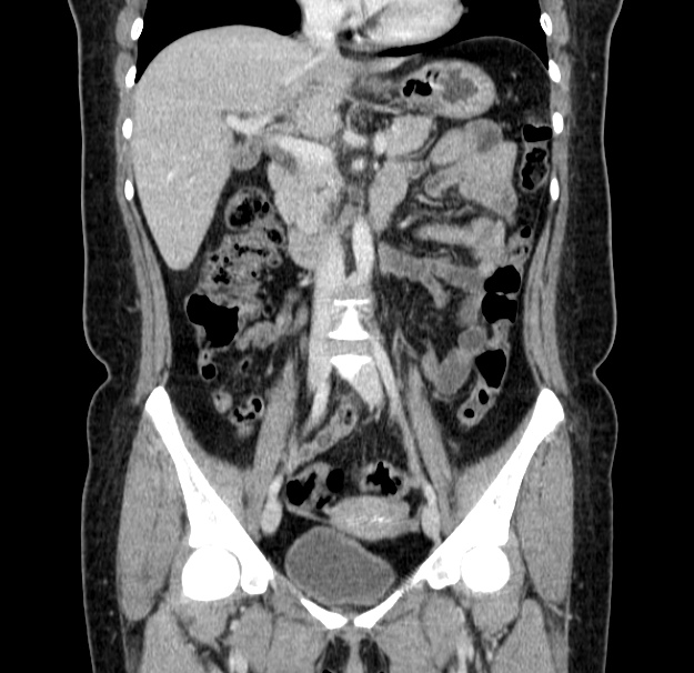 Choledocholithiasis on CT and MRI (Radiopaedia 24825-25087 C 23).jpg