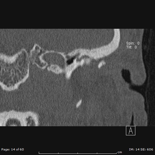 Cholesteatoma - external auditory canal (Radiopaedia 88452-105096 Coronal bone window 14).jpg