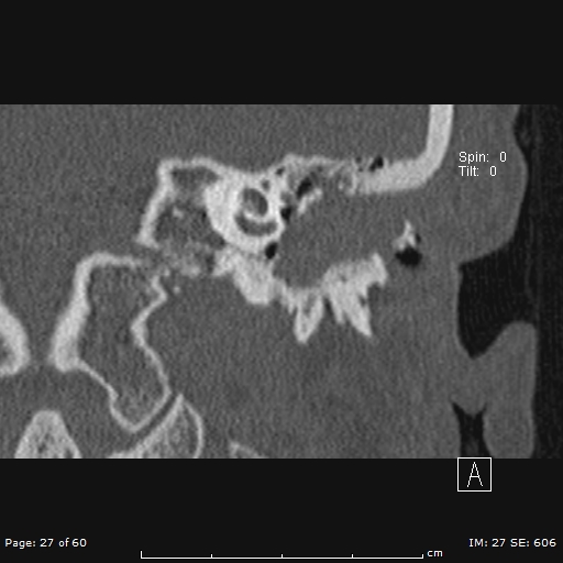 Cholesteatoma - external auditory canal (Radiopaedia 88452-105096 Coronal bone window 27).jpg