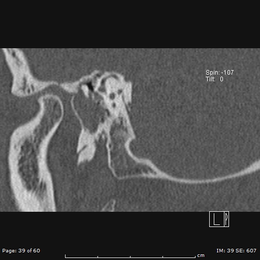 Cholesteatoma - external auditory canal (Radiopaedia 88452-105096 Sagittal bone window 39).jpg