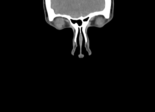 Chondroblastic osteosarcoma (Radiopaedia 67363-76741 D 6).jpg