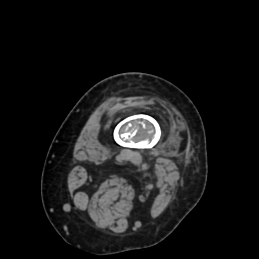 Chondrosarcoma - femur (Radiopaedia 64187-72954 Axial non-contrast 15).jpg