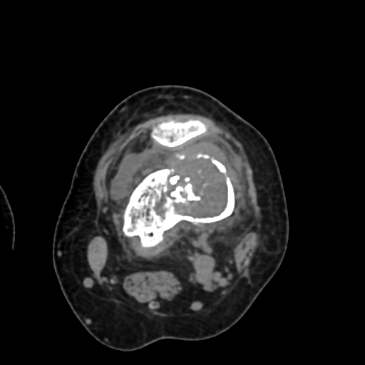 Chondrosarcoma - femur (Radiopaedia 64187-72954 Axial non-contrast 36).jpg