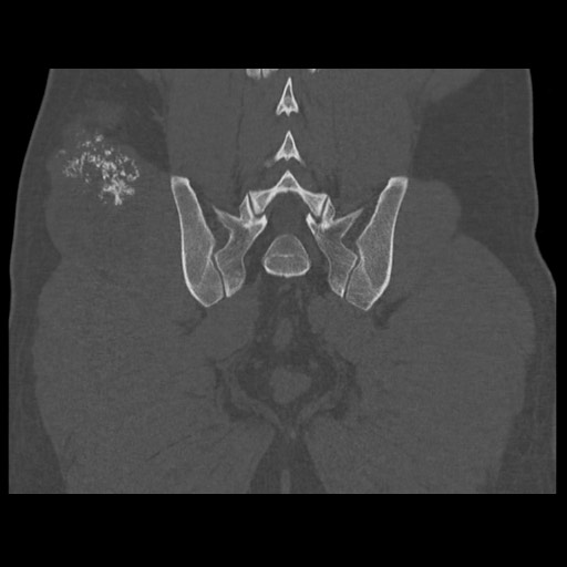 Chondrosarcoma of iliac wing (Radiopaedia 63861-72599 Coronal bone window 87).jpg