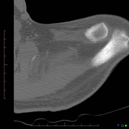 File:Chondrosarcoma of the scapula (Radiopaedia 30696-31399 Axial non-contrast 20).jpg