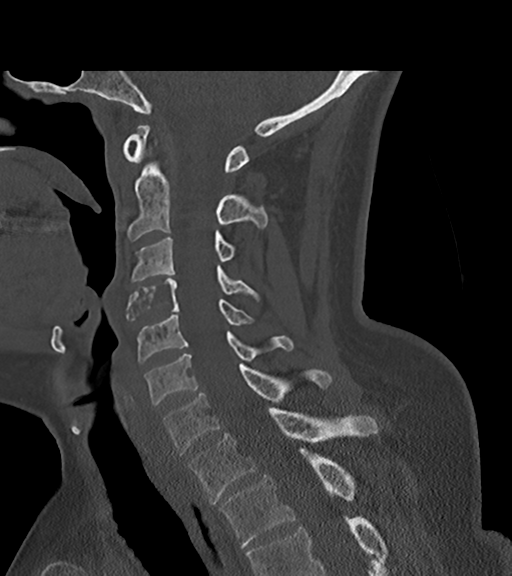 File:Chordoma (C4 vertebra) (Radiopaedia 47561-52188 Sagittal bone window 37).png