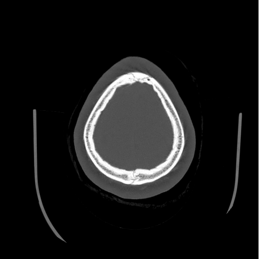 Choroid plexus papilloma extending into the cerebellopontine angle cistern (Radiopaedia 85941-101833 Axial bone window 83).png