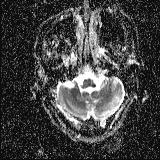 Choroid plexus xanthogranuloma - unilateral (Radiopaedia 85632-101393 Axial ADC 12).jpg