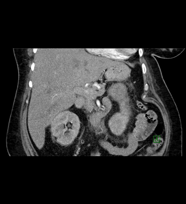 Chromophobe renal cell carcinoma (Radiopaedia 84239-99519 C 40).jpg