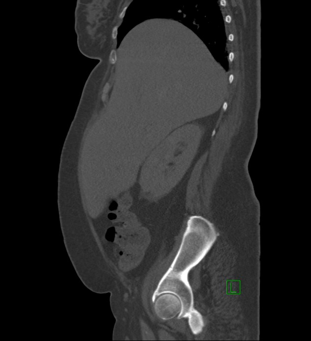 Chromophobe renal cell carcinoma (Radiopaedia 84239-99519 Sagittal bone window 80).jpg