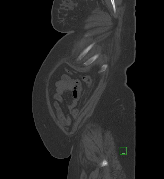 Chromophobe renal cell carcinoma (Radiopaedia 84239-99519 Sagittal bone window 9).jpg