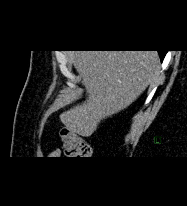 Chromophobe renal cell carcinoma (Radiopaedia 84286-99573 F 157).jpg