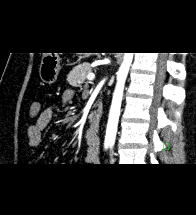 Chromophobe renal cell carcinoma (Radiopaedia 84286-99573 F 81).jpg
