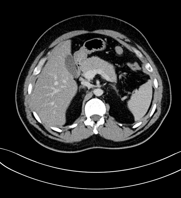 Chromophobe renal cell carcinoma (Radiopaedia 84286-99573 G 20).jpg