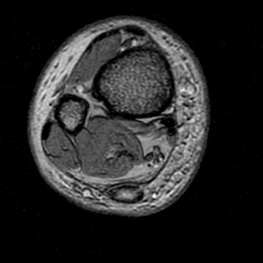 File:Chronic Achilles tendon rupture (Radiopaedia 15262-15100 Axial Gradient Echo 2).jpg