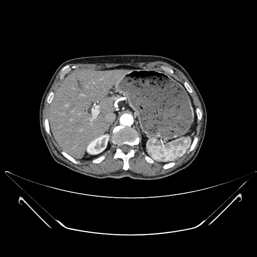 File:Chronic contained rupture of abdominal aortic aneurysm with extensive erosion of the vertebral bodies (Radiopaedia 55450-61901 A 3).jpg