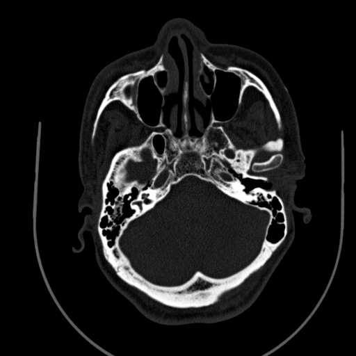 Chronic invasive fungal sinusitis (Radiopaedia 91563-109286 Axial sinus 37).jpg