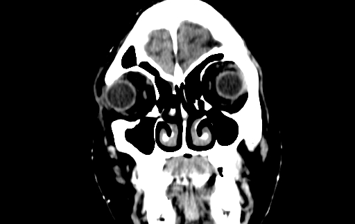 Chronic invasive fungal sinusitis (Radiopaedia 91563-109286 D 5).jpg