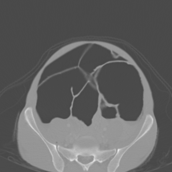 Chronic large bowel pseudo-obstruction (Radiopaedia 43181-46492 Axial bone window 128).jpg
