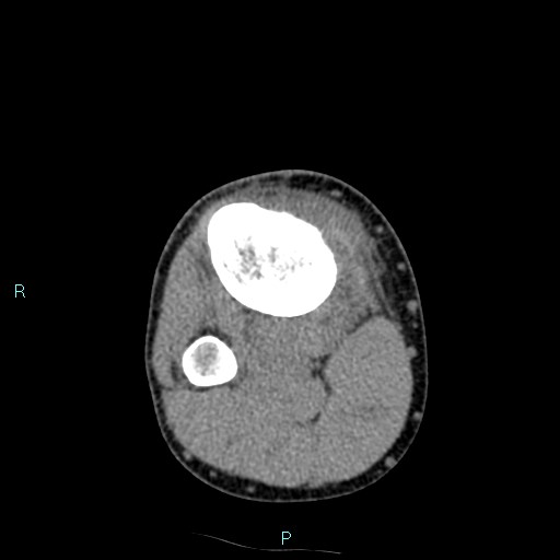 File:Chronic osteomyelitis (with Brodie abscess) (Radiopaedia 76405-88111 A 68).jpg