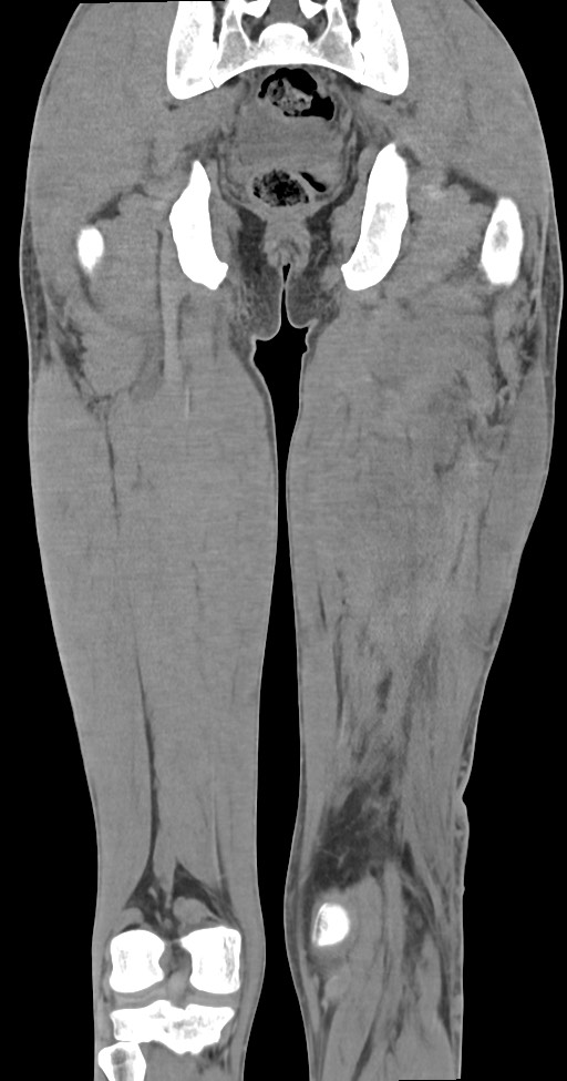 Chronic osteomyelitis (with sequestrum) (Radiopaedia 74813-85822 E 39).jpg