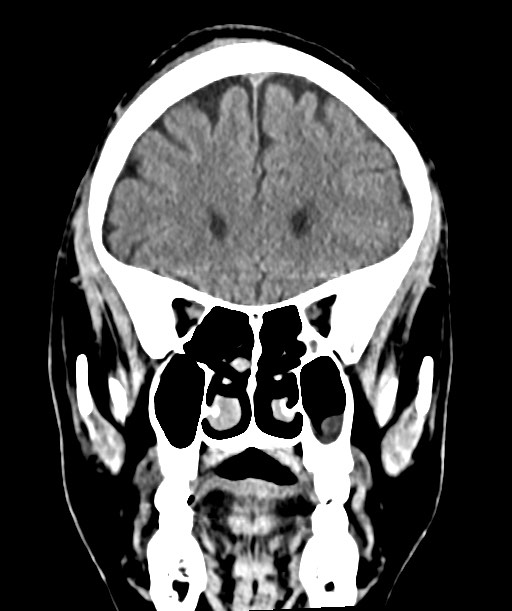 Chronic osteomyelitis - calvarial (severe) (Radiopaedia 69668-79616 Coronal non-contrast 23).jpg