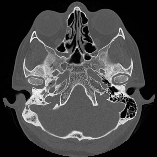 File:Chronic otomastoiditis (Radiopaedia 27138-27309 Axial bone window 21).jpg