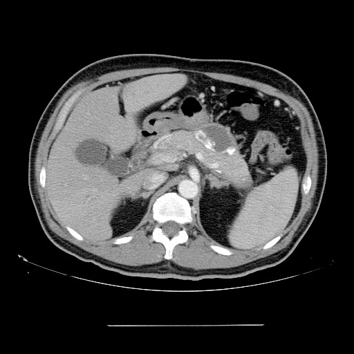 File:Chronic pancreatitis (Radiopaedia 11312-11676 E 1).jpg