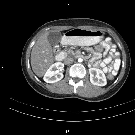 Chronic pancreatitis (Radiopaedia 64576-73450 B 61).jpg