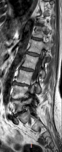File:Chronic spinal hematoma with cauda equina syndrome (Radiopaedia 75745-87090 Sagittal T1 5).png