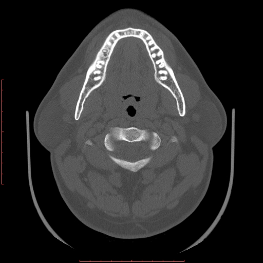 Chronic submandibular sialolithiasis (Radiopaedia 69817-79814 Axial bone window 45).jpg