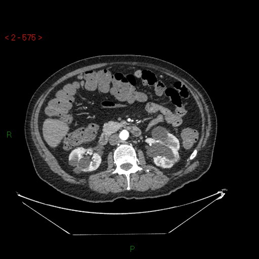 File:Circumaortic left renal vein and doubled left renal arteries (Radiopaedia 52268-58158 A 111).jpg