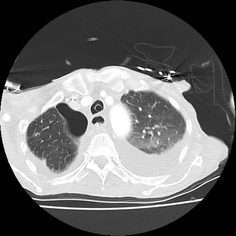 Clagett thoracotomy with bronchopleural fistula (Radiopaedia 29192-29587 Axial lung window 10).jpg