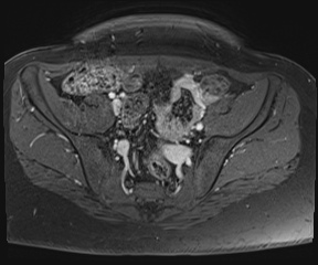File:Class II Mullerian duct anomaly- unicornuate uterus with rudimentary horn and non-communicating cavity (Radiopaedia 39441-41755 Axial T1 fat sat 27).jpg