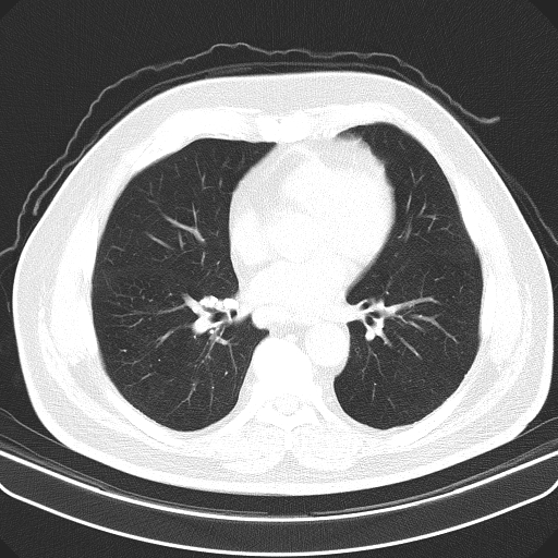 Classic complicated silicosis (Radiopaedia 49720-54961 Axial lung window 33).jpg