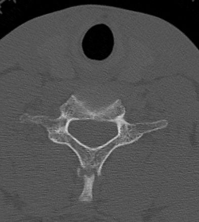 Clay-shoveler fracture (Radiopaedia 14604-14532 Axial bone window 27).jpg
