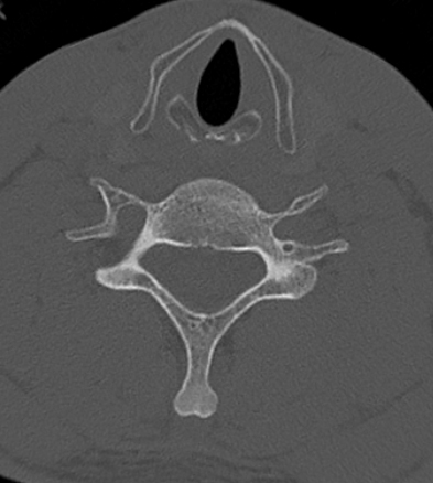 Clay-shoveler fracture (Radiopaedia 14604-14532 Axial bone window 4).jpg