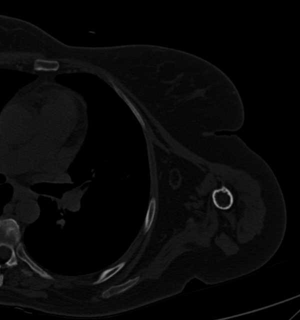 Clear cell chondrosarcoma - humerus (Radiopaedia 63104-71612 Axial bone window 81).jpg