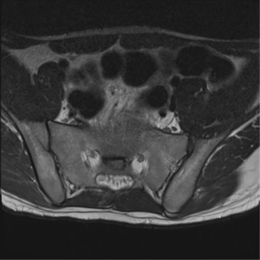 File:Clear cell meningoma - lumbar spine (Radiopaedia 60116-67690 Axial T2 1).png