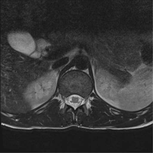 File:Clear cell meningoma - lumbar spine (Radiopaedia 60116-67690 Axial T2 46).png