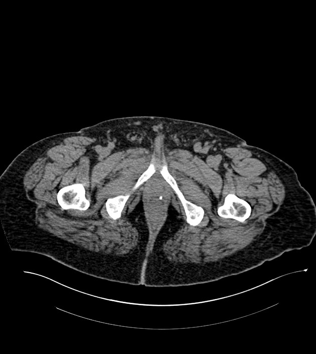 Closed-loop small bowel obstruction-internal hernia (Radiopaedia 78439-91096 Axial non-contrast 164).jpg